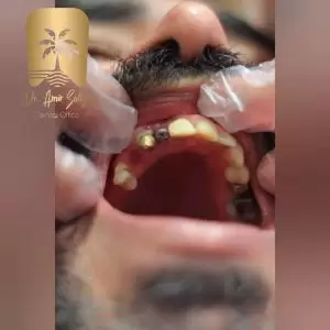 ایمپلنت