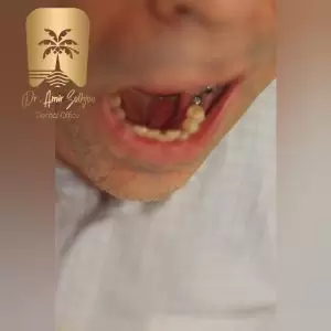 ایمپلنت