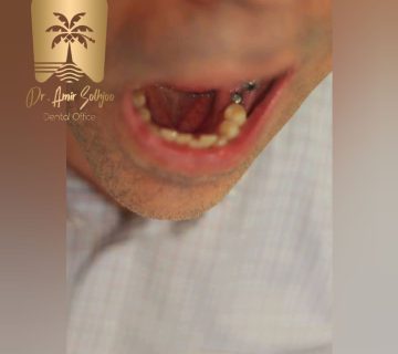 ایمپلنت