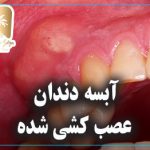 آبسه دندان