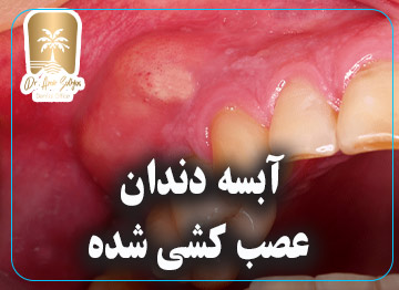 آبسه دندان
