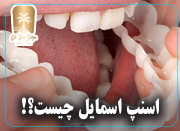 اسنپ اسمایل چیست؟!