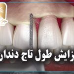 افزایش طول تاج دندان