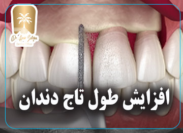 افزایش طول تاج دندان
