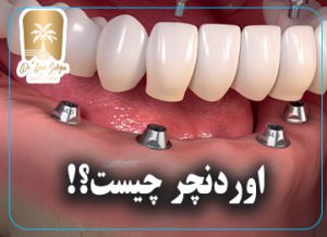 اوردنچر