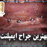 بهترین جراح ایمپلنت در تهران