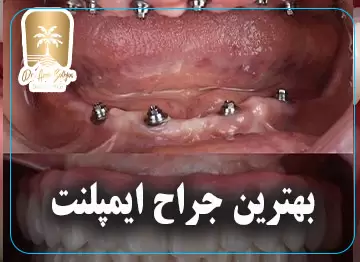 بهترین جراح ایمپلنت در تهران