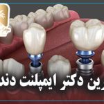 بهترین دکتر ایمپلنت دندان
