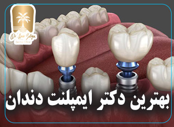 بهترین دکتر ایمپلنت دندان