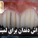 تراش دندان برای لمینت