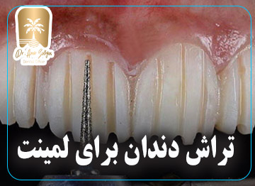 تراش دندان برای لمینت