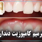 ترمیم کامپوزیت دندان