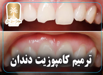 ترمیم کامپوزیت دندان