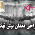 جراحی دندان نیش نهفته