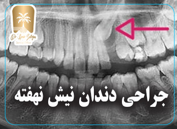 جراحی دندان نیش نهفته