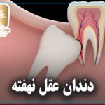 دندان عقل نهفته