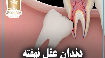 دندان عقل نهفته
