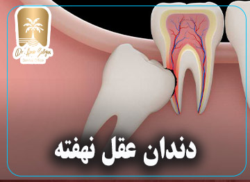 دندان عقل نهفته