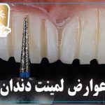 عوارض لمینت دندان