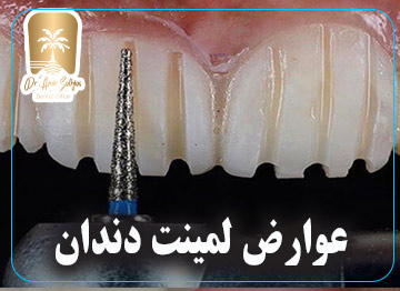 عوارض لمینت دندان