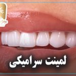 لمینت سرامیکی