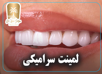 لمینت سرامیکی