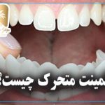 لمینت متحرک دندان