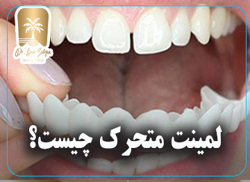 لمینت متحرک دندان