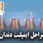 مراحل ایمپلنت دندان
