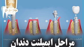مراحل ایمپلنت دندان