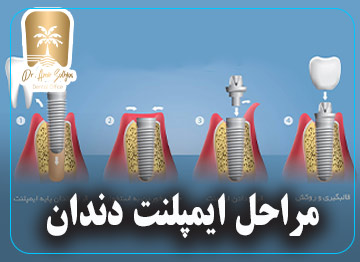 مراحل ایمپلنت دندان