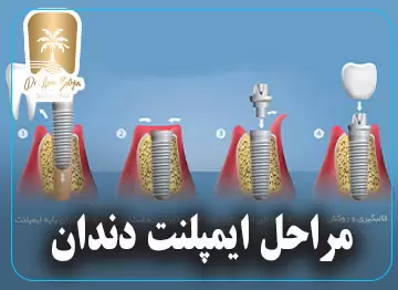 مراحل ایمپلنت دندان