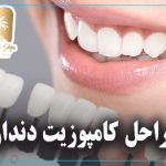 مراحل کامپوزیت دندان