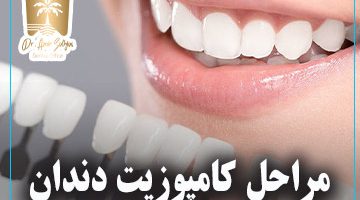 مراحل کامپوزیت دندان