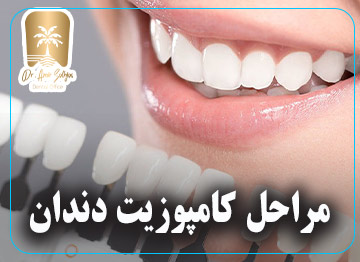 مراحل کامپوزیت دندان