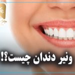 ونیر دندان