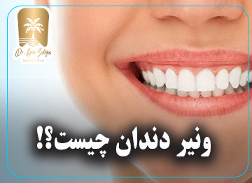 ونیر دندان