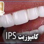 کامپوزیت IPS