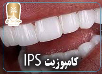 کامپوزیت IPS