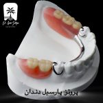 پروتز پارسیل