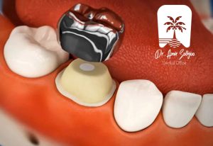 نصب اس اس کراون ss crown