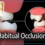 Habitual Occlusion