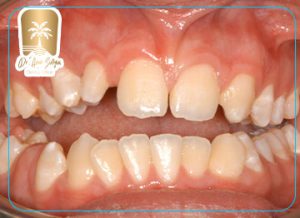 Habitual Occlusion