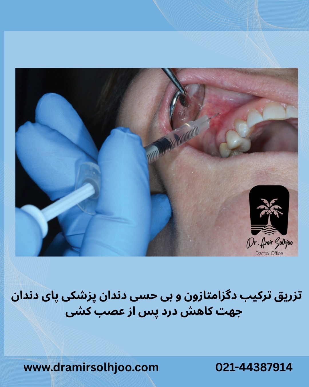 عصب کشی بدون درد