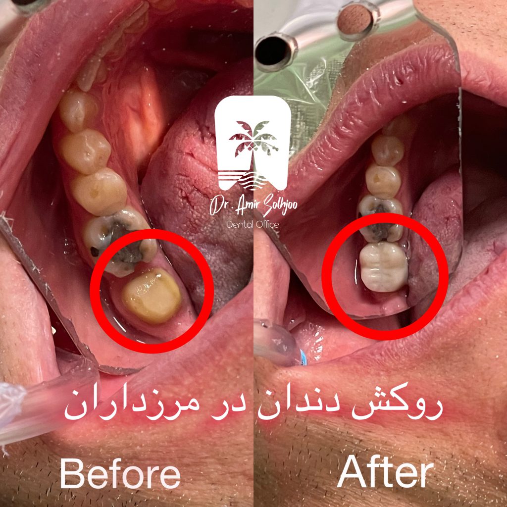 روکش پرسلنی