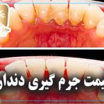 جرم‌گیری دندان‌