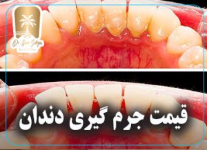 جرمگیری دندان