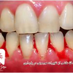 ژنژیویت در حاملگی