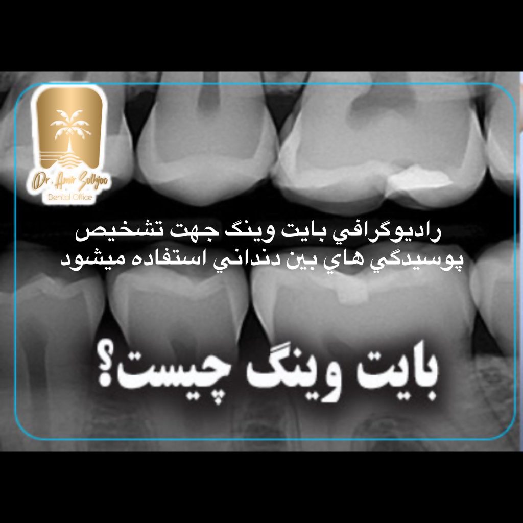 رادیوگرافی بایت وینگ
