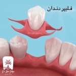 فلیپر دندان